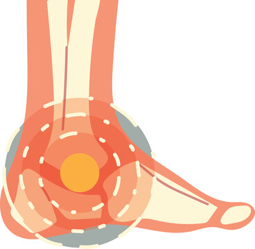 Anatomical illustration of a human ankle joint with highlighted pain point vector graphic