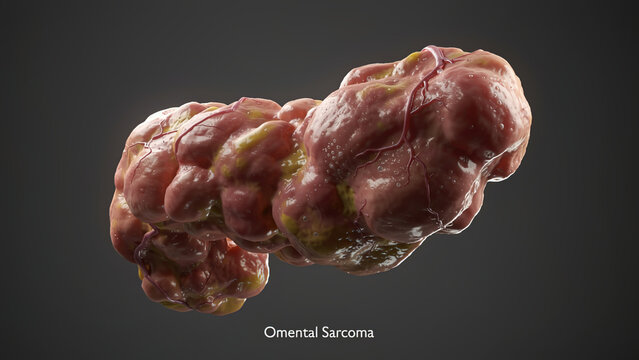 3D medical illustration of omental sarcoma tumor, isolated malignant abdominal neoplasm with blood vessels