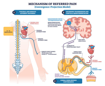Referred pain convergence projection, visceral and somatic inputs meet in dorsal horn, ascend to thalamus-cortex, brain maps heart pain to arm. Key objects, spinal cord, heart, brain. Outline diagram