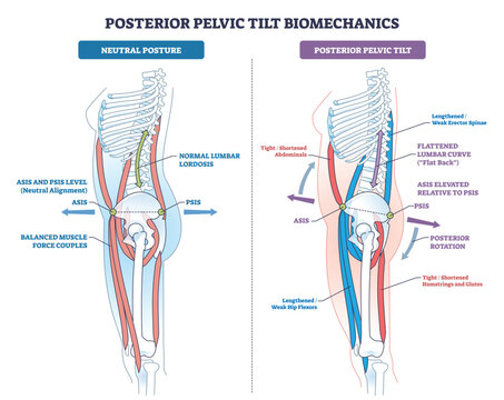 Posterior pelvic tilt biomechanics compares neutral and tilted posture, highlighting pelvis, lumbar spine, and muscle imbalances at ASIS-PSIS and rotation. Outline diagram