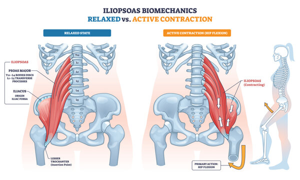 Iliopsoas biomechanics contrasts relaxed vs active contraction, showing the psoas-iliacus powering hip flexion, key objects, iliopsoas muscle, pelvis, lumbar spine. Outline diagram