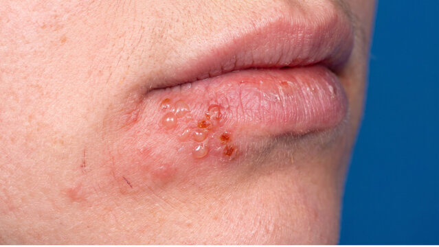 Cold sore blisters on the lower lip of a patient exhibit red, inflamed skin and clustered fluid-filled vesicles against a vibrant blue studio background.