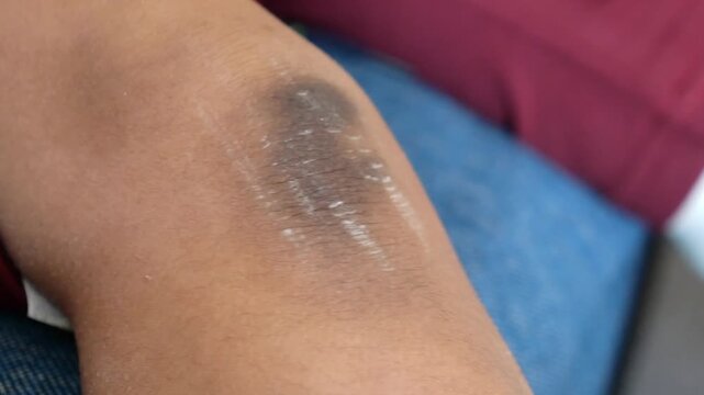 Close up of person scratching itchy dry skin on knee with dark hyperpigmentation and flaky texture