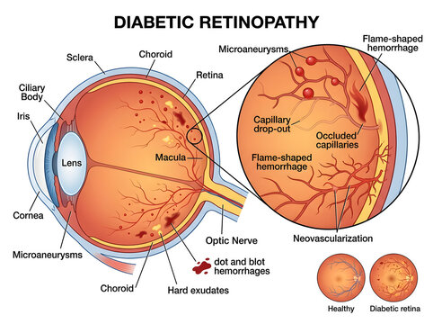 Diabetic retinopathy affecting the human retina with detailed labels isolated on white background