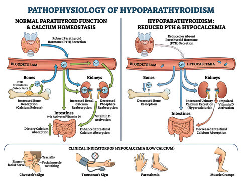 Pathophysiology of hypoparathyroidism and calcium homeostasis diagram isolated on white background