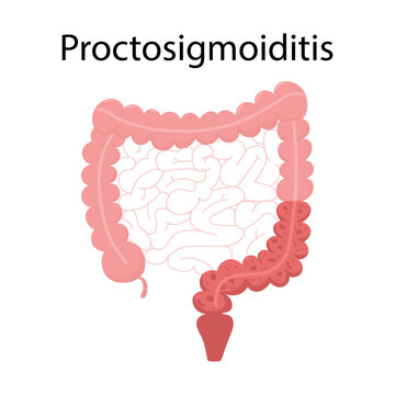 Proctosigmoiditis medical illustration showing inflamed rectum and sigmoid colon section with flat design anatomy diagram on clean white background