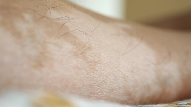 Macro view of human skin with visible depigmentation and vitiligo spots on leg