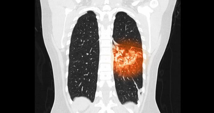 Coronal CT scan in bone window setting shows the ribcage and lungs affected by bronchogenic pneumonia.