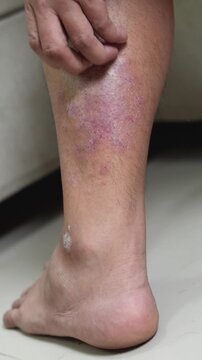 Men experience itchy legs due to germs and bacteria.