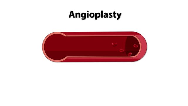 Angioplasty procedure showing a build up of cholesterol partially blocking blood flow through the artery.