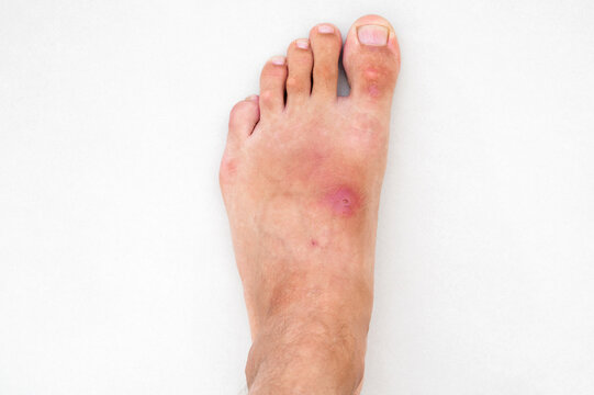 inflamed wound with a bacterial infection caused by an insect bite on human foot. A red abscess with pus on the skin of the leg close up on the white background