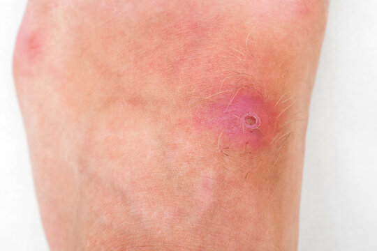 pustular wound with a bacterial infection on a human leg closeup. Red inflamed insect bite on the skin against a white background