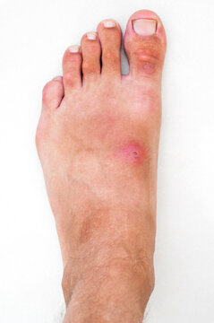 pustular wound with a bacterial infection on human leg. Red inflamed insect bite on the skin