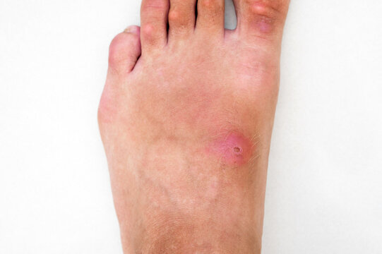 inflamed wound with a bacterial infection caused by an insect bite on a human foot. A red abscess with pus on the skin of the leg close up on the white background
