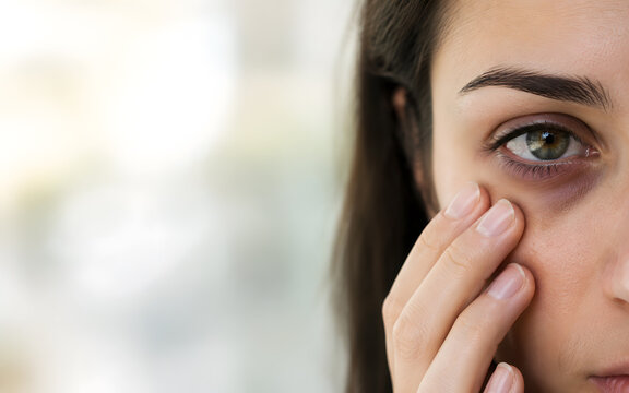Close Up of Woman Eye with Dark Circles and Eye Bags with Copy Space