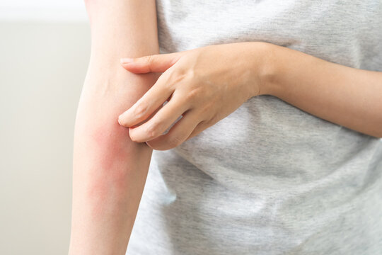 Dermatology asian young woman, girl allergy, allergic reaction from atopic, insect bites on arm, hand in scratching itchy, itch red spot or rash of skin. Healthcare, treatment of beauty on background.