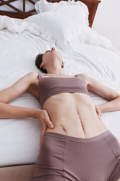Relaxed woman with scar lying on white bed