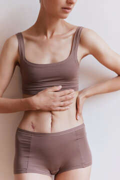 Anonymous Woman Touching Abdomen with Scar