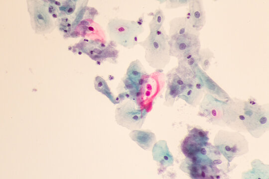 View in microscopic of abnormal human skin cells.Squamous epithelium cells.Superficial and intermediate epithelial cells.Cytology and pathology laboratory department.Magnification 400 X