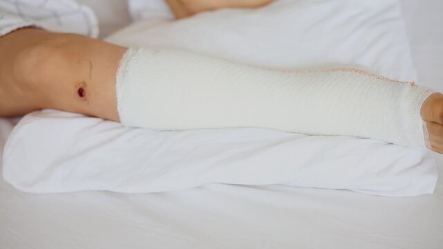 Children's leg in orthopedic cast on a white bed in the orthopedic department after first aid. Broken leg in a cast of an young child. 