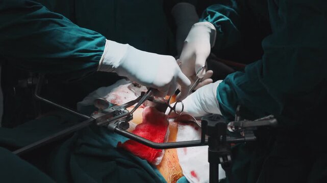 Surgeons carefully manipulate exposed tissue with clamps and forceps during an open abdominal procedure. Surgical precision, internal anatomy, hospital treatment, medical teamwork and clinical