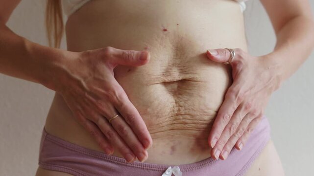 Woman checking condition of her abdominal skin during postpartum recovery period, 4K, closeup