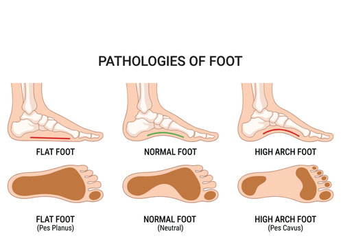Foot Pathology Anatomy Diagram Comparing Flat Foot Normal Foot and High Arch Foot Conditions