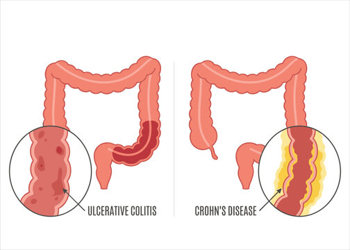 Ulcerative Colitis and Crohn's Disease Comparison Showing Inflammatory Bowel Disease Effects