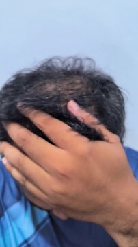 Middle Age Southeast Asian man touching thinning hair showing baldness bald patch on top of head