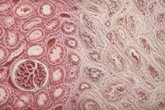 Chronic Kidney Scarring Compared With Healthy Renal Tissue