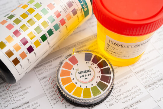 Urinalysis, urine cup with reagent strip pH paper test and comparison chart in laboratory.