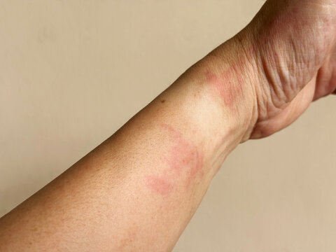 Close-up of red allergic skin rash and idiopathic dermatitis inflammation on a human wrist. Ideal for medical, healthcare, dermatology, and allergic reaction concepts.