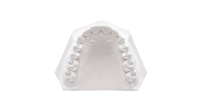 Dental plaster cast of human teeth, white orthodontic stone model for treatment planning, medical prosthetic dental mold isolated PNG with Transparent Background