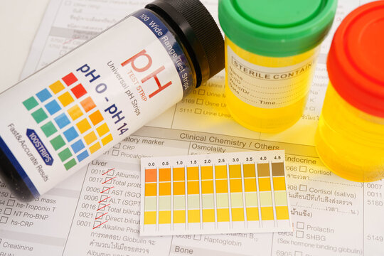 Urinalysis, urine cup with reagent strip pH paper test and comparison chart in laboratory.