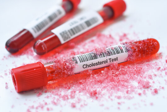 Cholesterol blood tube with sugar.  Blood sugar monitoring sugar metabolism and heart health. Blood tests can help assess glucose levels, lipid profiles, and other important health markers.
