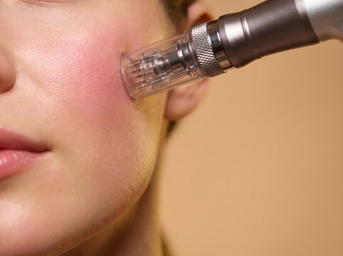 Macro close up of woman receiving microneedling mesotherapy treatment on cheek. Professional dermapen device with micro needles on red flushed skin. Anti aging skincare on beige background.