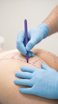 An extreme close-up of a plastic surgeon's hands using a surgical marker to draw surgical lines on a woman's buttocks for body contouring, minimalist aesthetic style