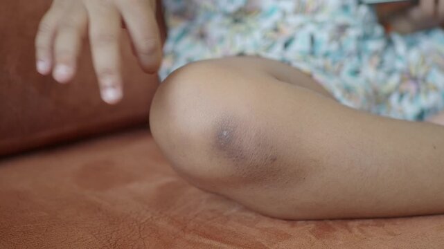 Close up of child hand scratching dark bruise on knee sitting on orange sofa indoors