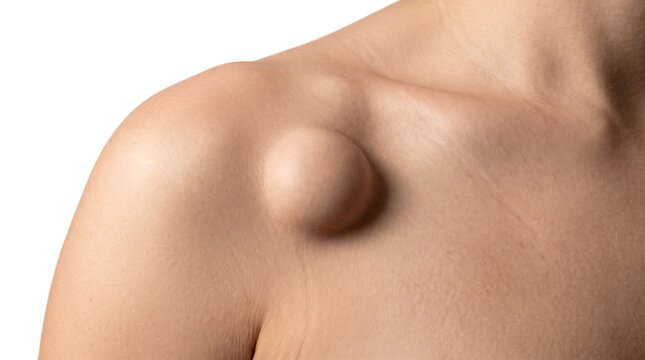 Close up of human shoulder with a large protruding subcutaneous lipoma, cyst or benign tumor
