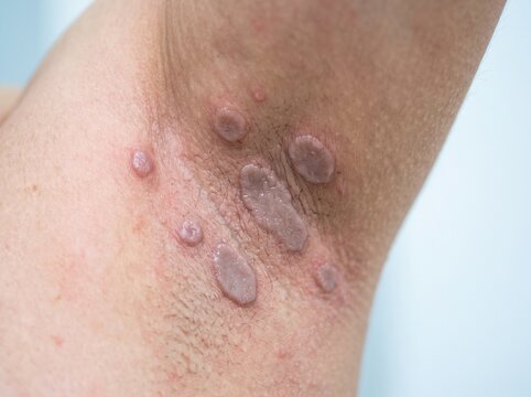 Condylomata lata skin lesions in secondary syphilis