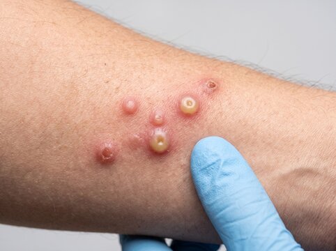 Mpox vesiculopustular skin lesions, infectious disease awareness
