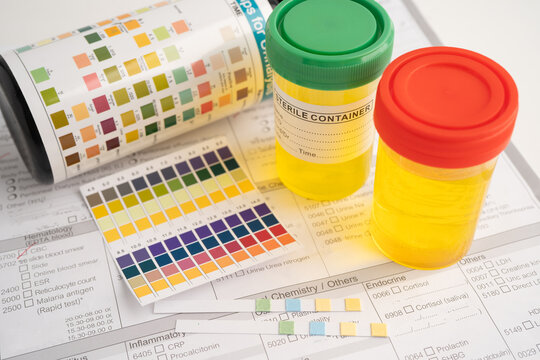 Urinalysis, urine cup with reagent strip pH paper test and comparison chart in laboratory.