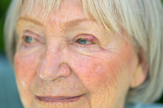 Senior Woman Eye With Stye