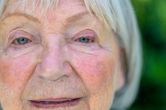 Senior Woman After Eye Surgery