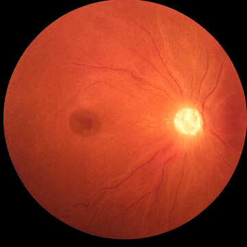 Close up retinal image showing optic disc and dark spot