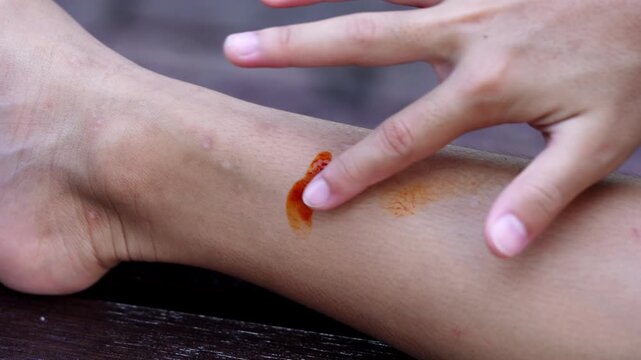 Close-up of applying antiseptic liquid povidone iodine to wound on leg for first aid treatment