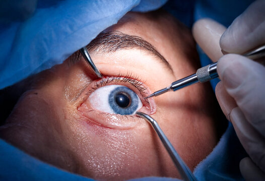 Medical professional performing delicate eye surgery procedure on patient