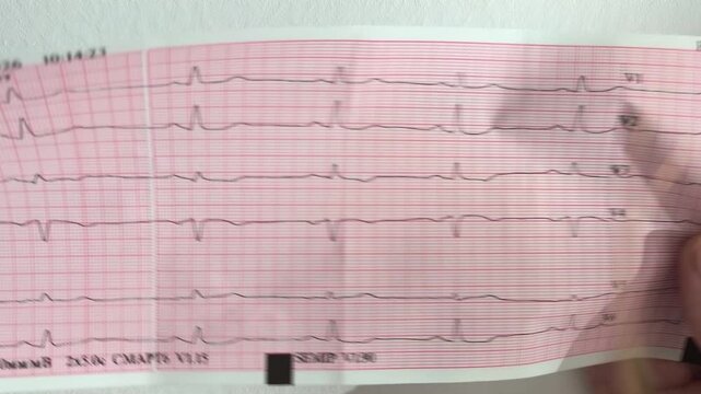 Arrhythmia detection review on an ecg cardiogram strip held by a medical expert. Doctor points at heartbeat deviations and irregular pulse intervals on paper chart. Cardiology diagnosis