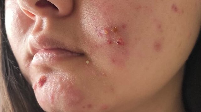 Close up of young woman with inflammatory acne and pus-filled pimples on her face, representing problem skin, adolescent acne, dermatology and skin care.
