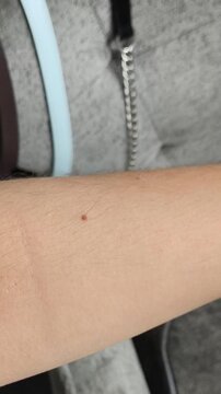 moles on the skin of a hand and arm, representing mole checking, skin examination, dermatology and monitoring of skin health.